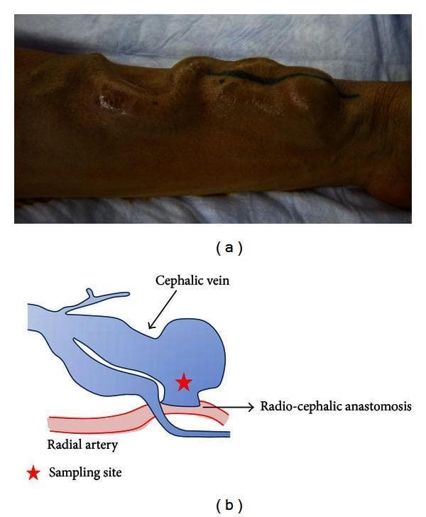 This composite educational material displays clinical and schematic representations of an overflow arteriovenous (AV) fistula. Panel (a) is a clinical photograph of a patient's forearm, showing a severely dilated, tortuous, and bulging cephalic vein characteristic of high-flow fistula complications. The overlying skin exhibits hyperpigmentation, scarring, and a black marking identifying a region of interest. Panel (b) is an anatomical diagram illustrating the underlying radio-cephalic anastomosis. It depicts the surgical connection between the radial artery (red) and the cephalic vein (blue), highlighting the resulting venous dilation and a specific sampling site marked with a red star near the anastomosis. This content is intended for medical education regarding hemodialysis access complications, vascular surgery, and the pathophysiology of high-flow AV fistulas in renal failure patients.