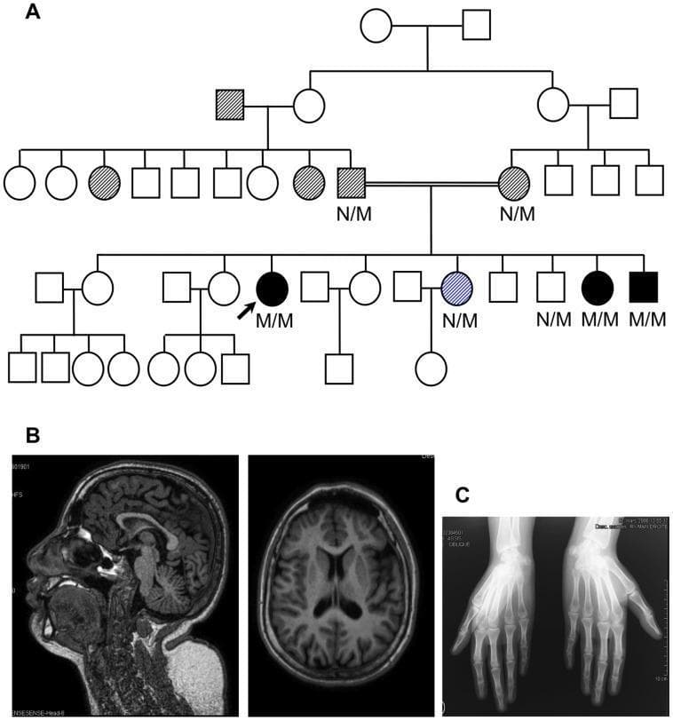 This composite educational figure consists of three panels representing a clinical case study of a genetic syndrome characterized by diabetes and microcephaly. Panel A is a pedigree diagram of a large consanguineous family. It illustrates an autosomal recessive inheritance pattern; affected individuals (black symbols) are homozygous (M/M) for a mutation, while carriers (hatched symbols) are heterozygous (N/M). Panel B presents T1-weighted MRI scans of the brain in sagittal and axial views. These images demonstrate primary microcephaly, showing a brain that is small for the patient's age but maintains normal anatomical architecture, including typical gyration and cortical folding patterns without gross malformations. Panel C is an anterior-posterior (AP) radiograph of both hands. The imaging shows normally shaped metacarpals and phalanges with an absence of epiphyseal dysplasia or significant skeletal deformities, illustrating that the clinical phenotype's growth abnormalities are primary to the central nervous system rather than generalized skeletal dysplasia. This figure is used to teach the clinical correlation between genetic variants (like TRMT10A) and multi-system neuro-metabolic disorders.