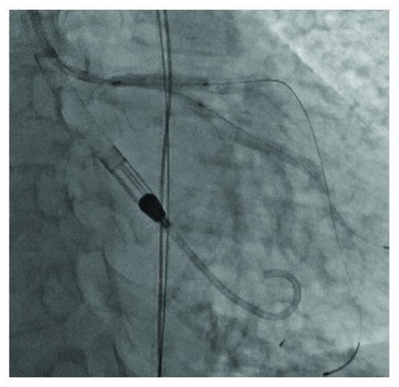 This diagnostic fluoroscopic image captures a Percutaneous Coronary Intervention (PCI) during a 'kissing balloon' dilation procedure. The angiogram displays the bifurcation of the left main coronary artery into the left anterior descending (LAD) and left circumflex (LCx) arteries. Two radiopaque coronary stents with a visible mesh-like morphology are positioned in tandem, extending from the left main artery into the LAD and LCx branches. Two distinct coronary guidewires are seen traversing the length of the stents and extending into the distal vasculature. Notably, two angioplasty balloons are simultaneously inflated at the bifurcation to ensure optimal stent expansion and bifurcation patency. A large-bore catheter (Impella device) is also visible in the cardiac silhouette, providing hemodynamic support. The image demonstrates complex interventional techniques for treating coronary bifurcation lesions, highlighting the use of simultaneous balloon inflation to prevent side-branch occlusion and maintain vessel geometry.