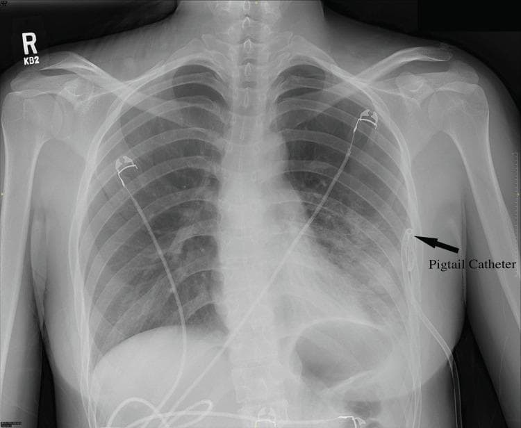 This anterior-posterior (AP) chest radiograph illustrates a large left-sided pneumothorax and its subsequent management. The left hemithorax exhibits a significant peripheral radiolucent area devoid of lung markings, indicating air within the pleural space. This results in medial retraction of the left lung towards the hilum, with a visible visceral pleural line. In contrast, the right lung remains fully expanded with normal bronchovascular markings reaching the chest wall. A radiopaque small-bore pigtail catheter is visible, inserted through the lateral left chest wall and terminating in a characteristic curled distal loop within the pleural space to facilitate air drainage and lung re-expansion. Radiopaque ECG leads are also present on the chest surface. This image is an educational example of diagnostic radiology in emergency medicine, demonstrating the visual characteristics of a simple pneumothorax and the correct positioning of a percutaneous pigtail catheter for thoracostomy.