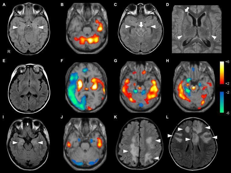 This composite figure presents brain neuroimaging findings comparing antibody-negative pediatric autoimmune encephalitis (AE), NMDA receptor encephalitis (NMDARE), and myelin oligodendrocyte glycoprotein-associated disease (MOGAD) using axial FLAIR MRI and 99mTc-ECD-SPECT. (A, C, D) FLAIR sequences in antibody-negative AE demonstrate hyperintense signals in the bilateral medial temporal lobes, brainstem, basal ganglia, and right insula. (B, F, G, H) Corresponding SPECT images utilize a Z-score color scale (range -6 to +6) to show regional perfusion abnormalities, including hyperperfusion (warm colors) in the left temporal lobe and cerebellum, and hypoperfusion (cool colors) in the right hemisphere. (I, J) NMDARE findings show medial temporal hyperintensities on FLAIR and bilateral temporal hyperperfusion on SPECT. (K, L) MOGAD is characterized by extensive, multifocal hyperintense lesions across the bilateral cerebral hemispheres on FLAIR. The collection illustrates the diagnostic utility of combining structural MRI with functional SPECT to identify metabolic and inflammatory patterns in pediatric neuroinflammatory disorders, highlighting that functional abnormalities may persist even when structural MRI appears normal (E).