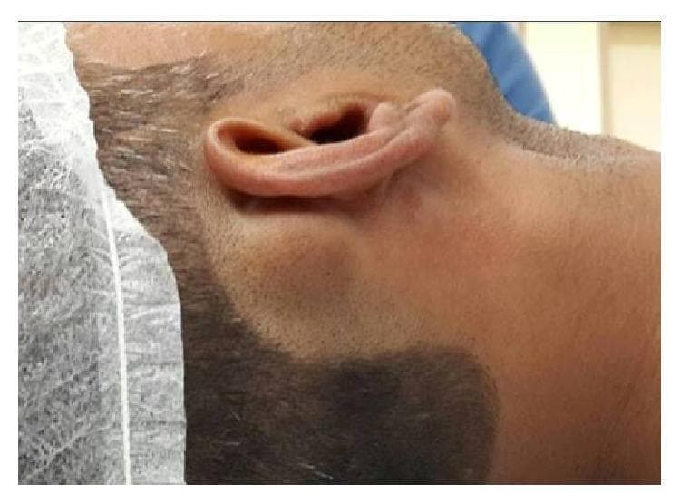 This clinical photograph shows a right-sided profile of a patient’s head, highlighting a significant swelling in the postauricular region. The mass is located directly behind the pinna, over the mastoid area. The swelling appears as a rounded, well-circumscribed, sessile protrusion that alters the natural contour of the head. The overlying skin is intact, smooth, and displays a normal color and texture without signs of erythema, inflammation, ulceration, or scarring. The ear itself appears normally positioned without significant anterior displacement, despite the proximity of the mass. This visual presentation is characteristic of a benign bony growth, such as a mastoid osteoma, and serves as an educational example for Otolaryngology and Dermatology residents in differentiating between soft tissue cysts (like sebaceous cysts) and hard, bony tumors in the postauricular space.