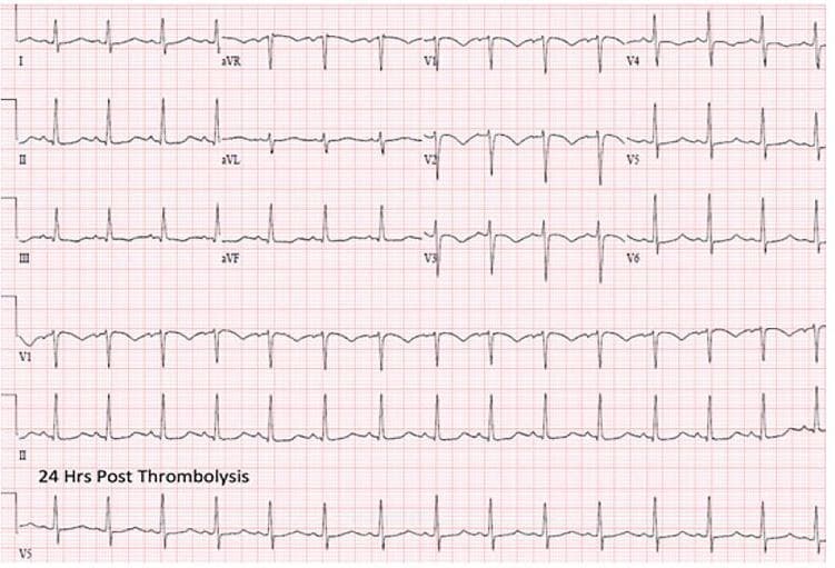 A 12-lead electrocardiogram (ECG) recorded on standard grid paper, labeled with the text '24 Hrs Post Thrombolysis'. The tracing displays a normal sinus rhythm with a heart rate of approximately 75-80 beats per minute. The QRS complexes are narrow and demonstrate a normal axis. Notably, the precordial leads (V1-V6) show a resolution of previous right bundle branch block (RBBB) and right heart strain patterns, with normal R-wave progression and the absence of S1Q3T3 morphology or significant ST-segment/T-wave abnormalities. This diagnostic image illustrates the clinical progression and electrical stabilization of the heart following successful thrombolytic therapy for a condition such as pulmonary embolism. The layout follows a standard 3-row, 4-column format for the 12 leads, supplemented by long rhythm strips of leads V1, II, and V5 at the bottom to aid in rhythm analysis.