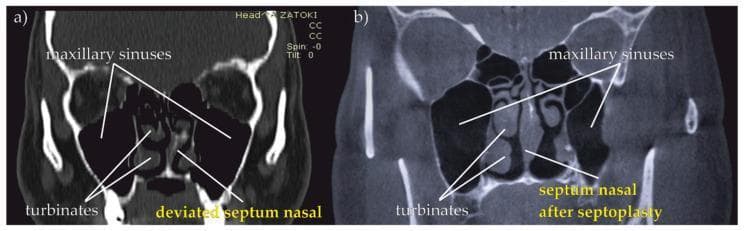 This Comparison Chart features two coronal Computed Tomography (CT) scans of the paranasal sinuses, providing a side-by-side visualization of a deviated nasal septum before and after surgical correction (septoplasty). Scan (a) demonstrates a prominent 'deviated septum nasal' with a distinct lateral curvature, causing asymmetry in the nasal airway and potentially obstructing the middle and inferior turbinates. Scan (b) illustrates the 'septum nasal after septoplasty,' showing a surgically straightened and midline-aligned septal wall, which restores bilateral patency to the nasal cavity. Both images highlight key anatomical landmarks including the maxillary sinuses (air-filled cavities lateral to the nasal walls) and the turbinates. These diagnostic images are essential for otorhinolaryngology education, specifically for demonstrating the clinical manifestation of upper respiratory tract (URT) obstruction and the efficacy of corrective surgical intervention in treating conditions like sleep apnea or chronic nasal congestion.