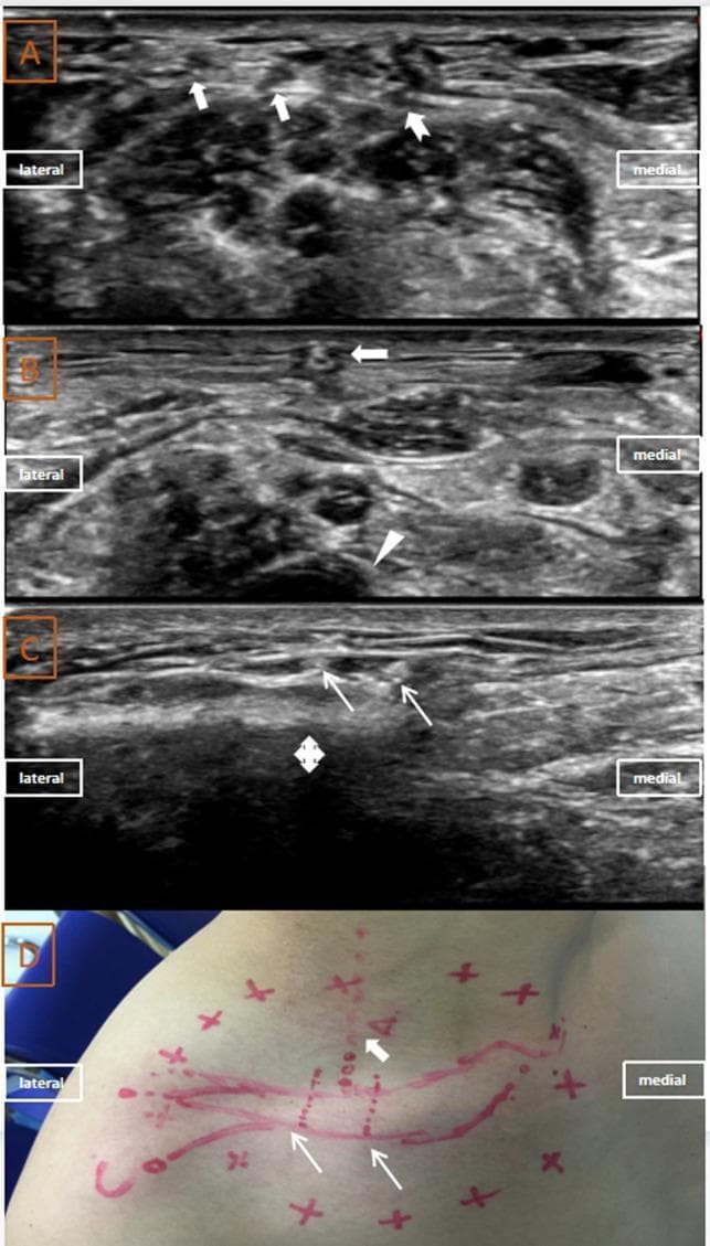 A multi-panel educational figure demonstrating the ultrasound-guided identification and surface mapping of the supraclavicular nerve. Panel A displays a transverse high-frequency ultrasound image of the neck at the posterior border of the sternocleidomastoid muscle, identifying hypoechoic dots representing the phrenic nerve (swallowtail arrow) on the scalenus anterior and branches of the superficial cervical plexus (thick white arrows) on the medial scalenus. Panel B shows a caudal progression, identifying a supraclavicular nerve branch (thick white arrow) situated anterior to the hypoechoic, oval supraclavicular artery (white arrowhead). Panel C depicts the nerve branches near the clavicle as fascicular hyperechoic masses (thin white arrows) superior to the bony landmark of the clavicle (cross arrow). Panel D is a clinical photograph showing surface markings on a patient’s shoulder/clavicular region, mapping the projected path of the supraclavicular nerve (white arrows) and the resulting sensory block area (red circles) following anesthetic injection. This material is designed for regional anesthesia training and peripheral nerve block localization.