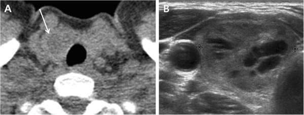 This dual-panel diagnostic image displays a comparison between Computed Tomography (CT) and Ultrasound (US) findings in a 49-year-old patient with an adenomatous goiter. Image A is an axial Low-Dose Helical CT (LDCT) scan of the neck at the level of the thyroid gland. An arrow identifies a 21 mm hypodense nodule within the right thyroid lobe; the lesion appears relatively uniform in density compared to the adjacent thyroid parenchyma and lacks internal calcification. Image B is a transverse grayscale ultrasound of the same right thyroid lobe, where calipers demarcate the nodule. The ultrasound reveals a heterogeneous, mixed solid and cystic composition, characterized by hypoechoic (fluid-filled) areas interspersed with isoechoic solid components. The image set illustrates the correlation between incidental thyroid nodules (ITNs) found on routine CT screening and their subsequent characterization via targeted ultrasonography, a common workflow in endocrinology and radiology for differentiating benign adenomatous changes from potentially malignant lesions.