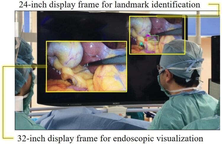 This clinical photograph illustrates a prototype computer-aided surgical navigation system during a laparoscopic cholecystectomy. The image shows a large 8K monitor being viewed by surgical staff in an operating room setting. The display is divided into two primary functional frames: a larger '32-inch display frame for endoscopic visualization' in the lower-left, showing real-time intraoperative footage of Calot's triangle and the gallbladder, and a smaller '24-inch display frame for landmark identification' in the upper-right. The secondary frame utilizes deep learning algorithms (YOLOv3) to overlay colored bounding boxes on specific anatomical landmarks, including the cystic duct, common bile duct, Rouviere’s sulcus, and the lower edge of the left medial liver segment (S4). This setup is designed to assist the surgeon in achieving the 'critical view of safety' by highlighting key biliary and vascular structures to prevent bile duct injuries. The arrangement demonstrates how artificial intelligence can be integrated into the surgical workflow without obstructing the primary operative view.
