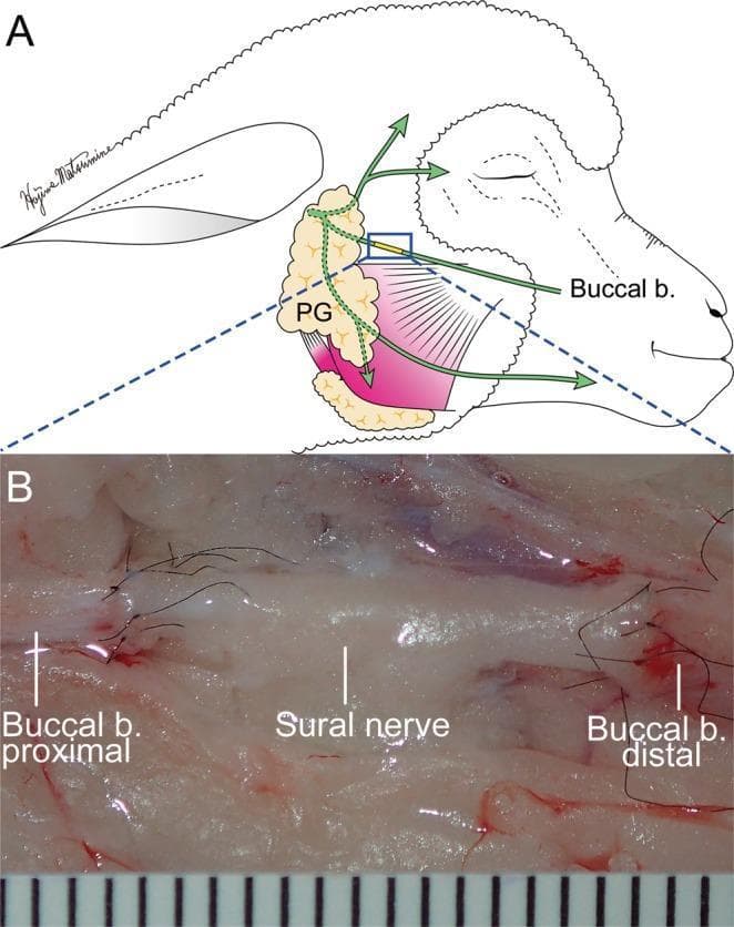This composite educational graphic illustrates the surgical repair of a facial nerve defect using a nerve graft. Panel A is an anatomical diagram showing a sural nerve graft bridging a defect in the buccal branch of the facial nerve. The schematic identifies the parotid gland (PG) as the proximal landmark, with the neurorrhaphy site located approximately 10 mm distal to the gland's edge. Panel B is a high-magnification intraoperative photograph demonstrating the microscopic end-to-end neurorrhaphy. A 15 mm segment of the sural nerve is shown interposed between the proximal and distal segments of the buccal branch. The surgical site features fine 10-0 nylon perineural sutures, visible as dark, thin filaments securing the anastomoses. A surgical ruler at the bottom provides a scale where each unit represents 1 mm. The image demonstrates key concepts in reconstructive microsurgery, including donor-recipient nerve diameter matching and tension-free epineural suturing for peripheral nerve restoration.