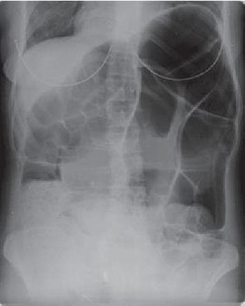 This diagnostic abdominal X-ray (supine view) demonstrates a classic case of sigmoid volvulus, a common cause of large bowel obstruction. The image reveals massive, disproportionate gaseous distention of a sigmoid colon loop, which has twisted on its mesentery. Two large, air-filled, dilated loops of bowel are seen arising from the pelvis and extending toward the upper abdomen, creating the characteristic 'coffee bean sign' or 'inverted U-loop' appearance. The medial walls of the dilated segments meet to form a thick central band. Key landmarks include the lack of haustral markings in the dilated sigmoid and a mottled pattern representing fecal material and gas in the lower abdomen and proximal colon. A nasogastric tube is visible entering the upper abdomen from the left side. This imaging is highly clinically significant for identifying mechanical bowel obstruction and torsion of the sigmoid colon, an emergency condition requiring prompt intervention such as endoscopic detorsion or surgical resection.