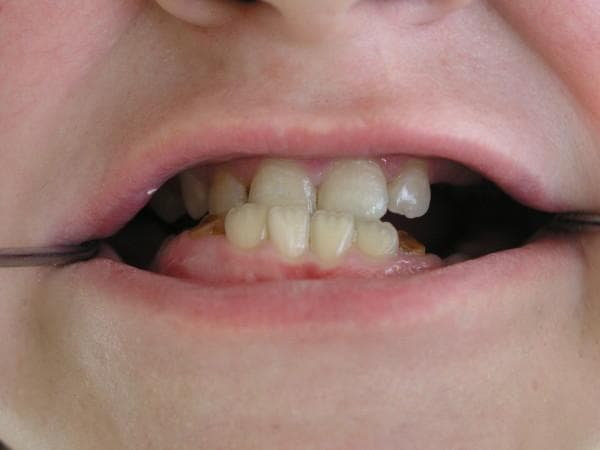 This intraoral clinical photograph demonstrates significant dental malocclusion and mandibular prognathism in a pediatric patient. The primary finding is a Class III malocclusion, where the lower jaw (mandible) and mandibular incisors are positioned anterior to the upper jaw (maxilla). The maxillary teeth exhibit moderate crowding, irregular alignment, and labial tilting. The lower teeth are noticeably protruded and angled forward. Additionally, there is evidence of gingival inflammation and potential dental caries, common oral manifestations in Hyper-IgE Syndrome (HIES). Two metal retractors are visible at the corners of the mouth to facilitate the clinical examination. The image serves as an educational example of craniofacial and dental abnormalities associated with primary immunodeficiency disorders.