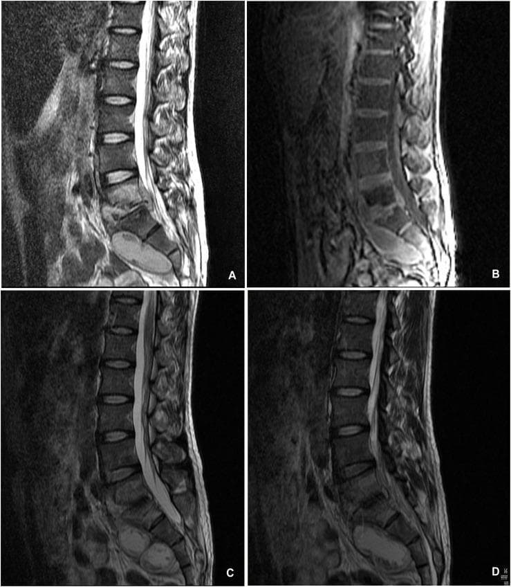 A comparison of sagittal lumbosacral spine imaging demonstrating the progression and resolution of spinal tuberculosis (Pott disease). Panels A and B are pretreatment sagittal MRI scans (T2-weighted and likely T1-weighted sequences) showing significant osseous destruction of the L5 and S1 vertebral bodies. A large, hyperintense prevertebral and paravertebral abscess is visible in the presacral space, causing mass effect and spinal cord compression at the lumbosacral junction. Panels C and D are follow-up sagittal MRI scans taken 15 months after conservative anti-tuberculosis therapy. These images show complete resolution of the fluid-filled abscesses and significant healing of the vertebral bodies. Evidence of spontaneous interbody fusion between L5 and S1 is present, with restoration of the lumbosacral angle and decompression of the neural elements. The series illustrates the efficacy of long-term pharmacological management in treating multi-level spinal infection, highlighting key diagnostic features such as vertebral endplate destruction, soft tissue abscess formation, and eventual bony stabilization.