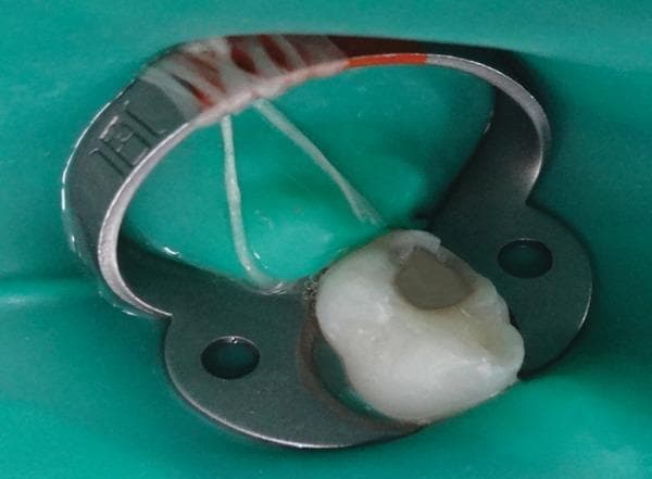 This clinical photograph demonstrates an intraoperative view of a molar undergoing dental treatment. The tooth is isolated using a green rubber dam system to maintain a dry, sterile field and prevent contamination during the procedure. A stainless steel rubber dam clamp (endodontic clamp) is secured around the cervical region of the tooth to stabilize the dam. The occlusal surface of the molar shows an extensive, prepared cavity involving the dentin, characteristic of dental caries removal. The internal walls of the cavity appear irregular and off-white, indicating the excavation of softened carious tissue. This procedural image illustrates a standard operative dentistry protocol for caries management, ensuring aseptic conditions before microbiological sampling or restoration with materials such as glass ionomer cement. The target audience includes dental students and practitioners focusing on restorative dentistry and endodontic isolation techniques.