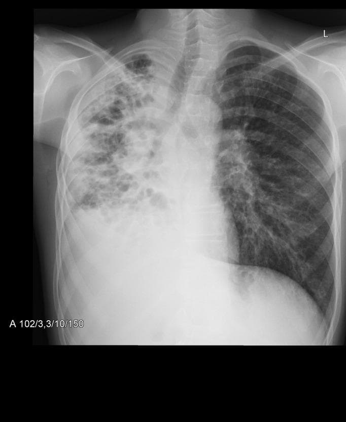 This diagnostic image is a posterior-anterior (PA) chest x-ray demonstrating advanced pulmonary pathology, characteristic of chronic obstructive or infectious lung disease such as cystic fibrosis. The right lung field exhibits significant volume loss (atelectasis) and a large inferior opacification consistent with pleural effusion or dense consolidation. The upper and middle zones of the right lung show a disorganized pattern of cystic and linear opacities, indicating extensive bronchiectasis and honeycombing. A resulting mediastinal shift toward the right is evident. In contrast, the left lung field displays compensatory hyperinflation with flattened diaphragmatic contours and increased radiolucency. Diffuse nodular and linear interstitial opacities are present throughout the left lung, suggesting widespread small-airway involvement. The radiographic findings are quantified by a modified Chrispin-Norman score of 27, reflecting high disease severity. This image serves as a teaching tool for recognizing the complex interplay of parenchymal destruction, airway remodeling, and volume shifts in chronic respiratory conditions.