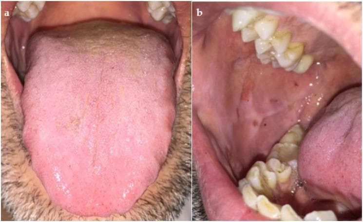 Two-panel clinical photograph illustrating the oral cavity following treatment for immune thrombocytopenic purpura (ITP). Image (a) presents a dorsal view of the tongue, demonstrating a pink, moist surface with normal filiform and fungiform papillae distribution. There is evidence of resolving ecchymosis, appearing as faint, darker spots near the lateral borders, indicating remission of previous hemorrhagic lesions. Image (b) shows the right buccal mucosa and dental arches. The mucosa is predominantly light pink and healthy, with minimal residual hyperpigmented macules likely representing resolving petechiae or ecchymoses. The adjacent teeth show mild extrinsic staining and dental calculus, while the gingival margins appear stable. Collectively, these images document the clinical resolution of oral manifestations of a bleeding disorder—specifically the healing of traumatic-origin ecchymotic areas and mucosal hemorrhages—following corticosteroid therapy.