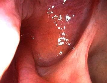 This endoscopic clinical photograph displays a postoperative view of the skull base 10 months following the repair of a clival cerebrospinal fluid (CSF) leak. The image highlights a successfully healed surgical site, showing the results of a multi-layer closure technique that utilized an onlay bovine pericardium graft, fibrin sealant, and a pedicled nasoseptal flap. The mucosal surface is notably smooth, continuous, and well-vascularized, appearing healthy with a pinkish-red hue. There is an absence of visible defects, graft displacement, dehiscence, or mucosal irregularities, indicating complete tissue integration and successful sealing of the initial skull base defect. No signs of active inflammation, crusting, or recurrent rhinorrhea are present, confirming stable long-term recovery within the otolaryngological and neurosurgical domain.