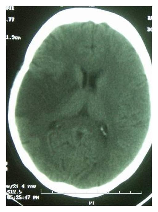 This diagnostic image is an axial non-contrast computed tomography (CT) scan of the brain, demonstrating a large acute ischemic stroke. The primary pathology is a massive territory infarct involving the right middle cerebral artery (MCA) distribution. Key radiological findings include a broad area of hypoattenuation (reduced density) in the right cerebral hemisphere, accompanied by the loss of normal grey-white matter differentiation and sulcal effacement, indicating cytotoxic edema. A notable diagnostic feature is the 'hyperdense MCA sign' visible within the right Sylvian fissure, representing acute thrombus or embolus within the M1 segment of the middle cerebral artery. The image also displays evidence of mass effect, including partial compression of the right lateral ventricle and a subtle midline shift toward the left. This visual provides a classic educational example of early CT signs of major vascular occlusion and territory-wide cerebral infarction suitable for neurology and radiology curricula.