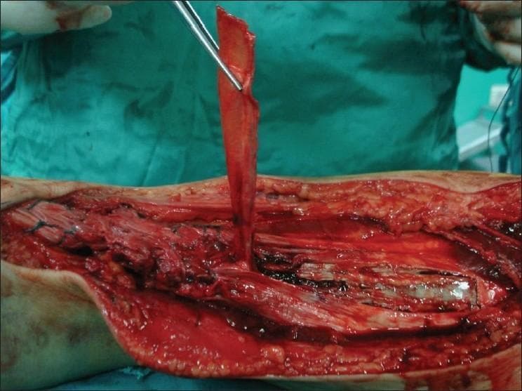 A peroperative clinical photograph demonstrating a surgical reconstruction of the Achilles tendon. The image shows an open surgical site on the posterior aspect of the lower leg. A surgical instrument is lifting a long, rectangular strip of gastrosoleus fascia, which appears as a thin, vascularized, light pink-to-red tissue flap. This fascial strip is being harvested as a pedicled graft to reinforce the Achilles tendon repair. The underlying surgical bed reveals deep dissection through subcutaneous adipose tissue and skeletal muscle, exhibiting a moist, reddish-brown texture with visible muscle fibers. This visual illustrates a specific orthopedic technique for managing chronic or complex Achilles tendon ruptures by using local fascial augmentation to bridge defects or strengthen the primary repair site.