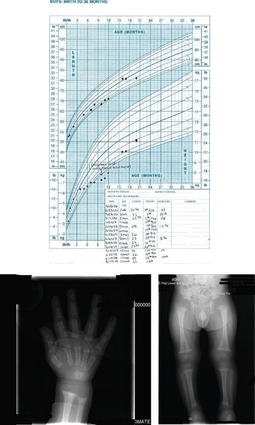 Educational composite image illustrating the clinical and radiological manifestations of nutritional rickets and subsequent recovery. The top panel features a pediatric growth chart (Birth to 36 months) documenting length and weight percentiles. It shows an initial period of growth failure followed by significant catch-up growth following therapeutic intervention with vitamin D and calcium. The bottom-left panel is a diagnostic radiograph of a pediatric hand and wrist, demonstrating classic rachitic changes including metaphyseal fraying and cupping of the distal radius and ulna, along with similar fraying at the distal aspects of the second through fifth metacarpals. The bottom-right panel displays a radiograph of the lower extremities, showing bilateral metaphyseal widening, cupping, and fraying at the distal femurs and proximal/distal tibiae. These findings are characteristic of impaired mineralization at the growth plates. The material serves as an educational resource for pediatric endocrinology and radiology, focusing on the diagnosis of metabolic bone disease and the monitoring of treatment efficacy in nutritional rickets.