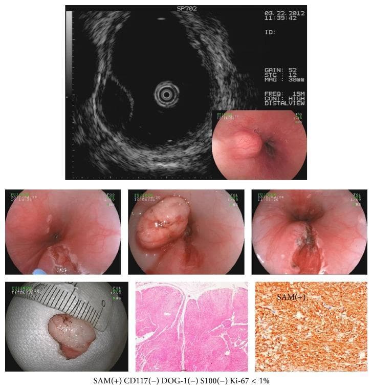 Educational composite image documenting an esophageal leiomyoma through multiple modalities. The top row features an Endoscopic Ultrasonography (EUS) scan showing a hypoechoic, well-circumscribed mass originating from the muscularis propria, alongside an initial endoscopic view of a subepithelial bulge. The middle row presents white-light endoscopy images of a raised, smooth-surfaced, hemispherical subepithelial tumor (SET) protruding into the esophageal lumen, showing intact overlying mucosa and normal vascularity. The bottom row displays a gross specimen measured against a centimeter scale, followed by histopathological analysis. The Hematoxylin and Eosin (H&E) stain shows fascicles of spindle cells with eosinophilic cytoplasm and minimal atypia. A corresponding immunohistochemistry (IHC) slide labeled 'SAM(+)' shows strong diffuse positive staining for smooth muscle actin (SMA), while the accompanying text notes negative results for CD117, DOG-1, and S100, and a low Ki-67 proliferation index (<1%), confirming the diagnosis of a benign mesenchymal tumor of myogenic origin.