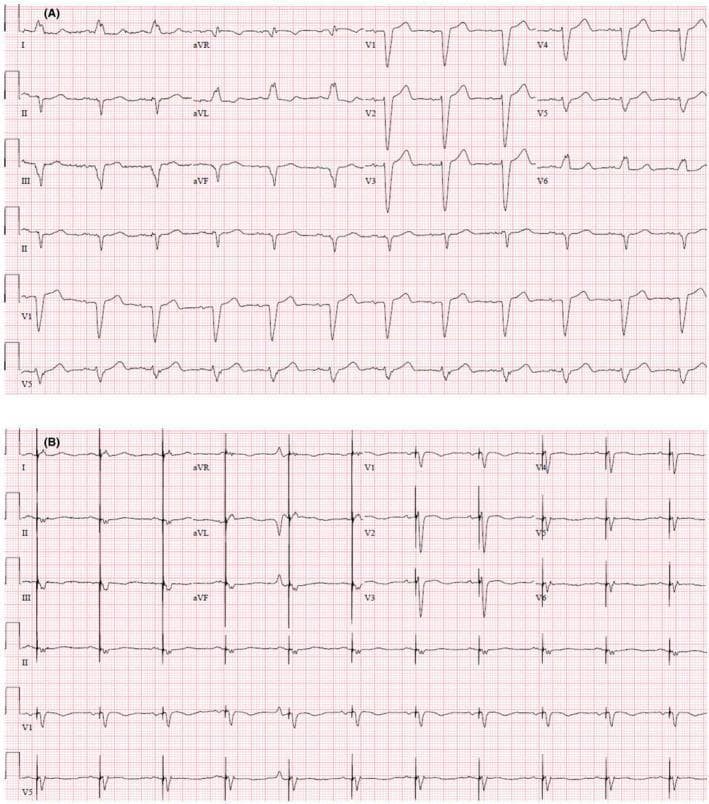 This diagnostic image displays a comparison between two 12-lead electrocardiograms (ECG) labeled A and B. Panel A (Baseline ECG) shows normal sinus rhythm with characteristic features of left bundle branch block (LBBB), including a prolonged QRS duration of 150 ms, wide slurred R waves in leads I and aVL, and deep S waves in leads V1-V3. Panel B (Post-CRT-P ECG) demonstrates the electrical changes following the implantation of a cardiac resynchronization therapy pacemaker. Key features in Panel B include visible pacing artifacts (vertical spikes) preceding the QRS complexes, indicating ventricular pacing. The QRS complex in the post-procedure ECG is slightly narrower (140 ms) compared to baseline, though still wider than normal, and exhibits T-wave inversions discordant with the paced QRS complexes. This comparison highlights the impact of biventricular pacing on ventricular depolarization and repolarization patterns in a patient with heart failure and LBBB.