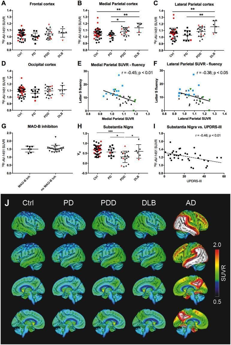 This composite educational graphic presents multi-modal diagnostic data investigating 18F-AV-1451 (tau PET tracer) retention in neurodegenerative synucleinopathies compared to Alzheimer’s Disease (AD).
