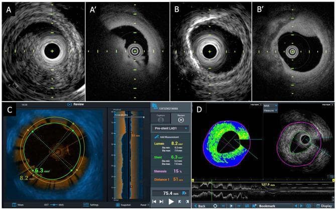This composite diagnostic image showcases a TERUMO hybrid intravascular imaging system, comparing Intravascular Ultrasound (IVUS) and Optical Coherence Tomography (OCT) modalities in a cadaver coronary artery. Panels A and A' compare IVUS (grayscale, lower resolution) and OCT (higher resolution) for visualizing a thrombus, which appears as a distinct crescent-shaped mass in the OCT image. Panels B and B' demonstrate the visualization of vascular calcification; IVUS shows significant acoustic shadowing, while OCT provides higher superficial resolution of the calcified plaque. Panel C displays a fused IVUS-OCT interface with color mapping for tissue characterization and quantitative metrics, including lumen area (8.2 mm²), stent diameter (6.3 mm), and 15% stenosis. Panel D presents Integrated Backscatter IVUS (IB-IVUS) with color-coded plaque analysis (green and blue) and longitudinal vessel reconstruction. These images highlight the complementary nature of IVUS (greater penetration) and OCT (higher resolution) for intracoronary plaque assessment and percutaneous coronary intervention (PCI) guidance.