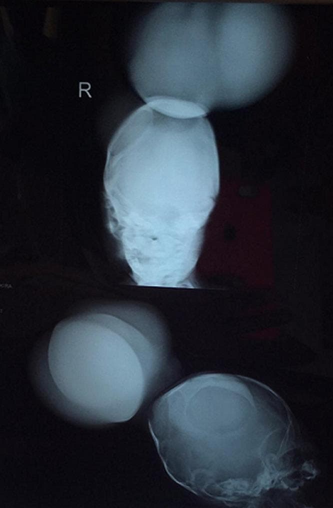This diagnostic X-ray series displays frontal and lateral radiographic views of a pediatric skull, demonstrating a significant occipital bone defect. In both projections, there is a clear discontinuity in the posterior cranial vault through which a large, soft-tissue density mass protrudes, consistent with an occipital encephalocele. The frontal view highlights the central positioning of the defect relative to the cranial midline, while the lateral view illustrates the posterior extent of the herniated intracranial contents. The surrounding cranial bones appear thin, typical for a neonate or infant. This clinical imaging is representative of a neural tube defect where failure of the skull to fuse results in the extracranial herniation of brain tissue and meninges. Such findings are critical in the diagnosis and surgical planning for congenital craniofacial anomalies and associated conditions like amniotic band syndrome.