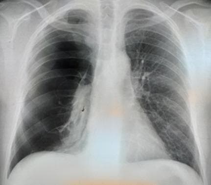 A posterior-anterior (PA) chest X-ray demonstrating a large, total right-sided pneumothorax. The right hemithorax shows marked hyperlucency with a complete absence of bronchovascular lung markings between the chest wall and the visceral pleural line. The right lung is collapsed toward the hilum, appearing as a dense, shrunken radiopaque mass medial to the pleural space. There is a visible sharp visceral pleural edge. The mediastinum remains relatively midline without significant deviation, suggesting the absence of immediate tension physiology at the time of imaging. In contrast, the left lung exhibits normal expansion, normal radiodensity, and preserved vascular markings extending to the periphery. The diaphragm on the right appears slightly flattened compared to the left. This diagnostic image illustrates a common complication of underlying pulmonary emphysema, serving as a classic representation of spontaneous pneumothorax for medical students and clinicians.