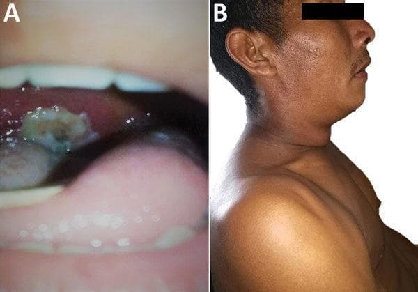 This composite clinical photograph displays the hallmark signs of respiratory diphtheria in a 31-year-old male. Image A is an intraoral view of the oropharynx showing a thick, adherent, gray-white pseudomembrane covering the tonsillar and pharyngeal area. The membrane appears leathery and rough in texture, a characteristic finding caused by the necrotizing exotoxin of Corynebacterium diphtheriae. Image B is a lateral profile of the same patient demonstrating significant soft tissue swelling of the cervical region, commonly referred to as a 'bull-neck' appearance. This manifestation is due to massive cervical lymphadenopathy and associated perilymphatic edema. These images serve as a classic diagnostic reference for medical professionals and students to identify the infectious manifestations of diphtheria, emphasizing the clinical triad of pharyngitis, pseudomembrane formation, and profound cervical swelling.