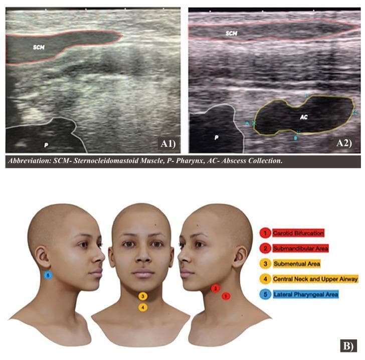 This composite educational graphic combines sagittal ultrasonography images and a 3D anatomical reproduction to illustrate a diagnostic protocol for the lateral pharyngeal area. Section A presents a side-by-side comparison of normal (A1) and pathological (A2) anatomy. In the normal scan, the sternocleidomastoid muscle (SCM) is visible superficially, with the pharynx (P) identified via the airway column shadow. In the affected scan (A2), a distinct, hypoechoic abscess collection (AC) is visualized, causing anatomical distortion and deviation of the pharyngeal structures. Section B provides a 3D anatomical model of the head and neck, mapping five key examination zones: (1) carotid bifurcation, (2) submandibular area, (3) submental area, (4) central neck and upper airway, and (5) lateral pharyngeal area. This resource is designed for clinical imaging instruction, demonstrating how point-of-care ultrasound can detect deep neck space infections and localized collections while outlining a systematic scanning protocol for the cervical region.