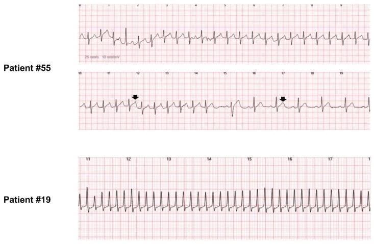 This diagnostic image displays three electrocardiography (ECG) rhythm strips recorded by a watch-type wearable device (w-ECG) for two different patients. The upper two strips (Patient #55) illustrate paroxysmal supraventricular tachycardia (PSVT), specifically atrioventricular nodal reentrant tachycardia (AVNRT), fast-slow type. Black arrows highlight distinct differences in T-wave morphology between tachycardia and sinus rhythm phases, indicating variations in ventricular repolarization. The middle strip captures the sudden termination of tachycardia with an 'A-no-V' mode of termination. The bottom strip (Patient #19) demonstrates a narrow QRS complex tachycardia characterized by a regular, rapid rhythm and consistent morphology, later diagnosed as atypical atrial flutter following radiofrequency catheter ablation for atrial fibrillation. The comparison demonstrates the clinical utility of w-ECG devices in discriminating QRS morphology, detecting P-waves, and identifying subtle repolarization changes in cardiac arrhythmias like SVT and atrial flutter for diagnostic and post-procedural monitoring.