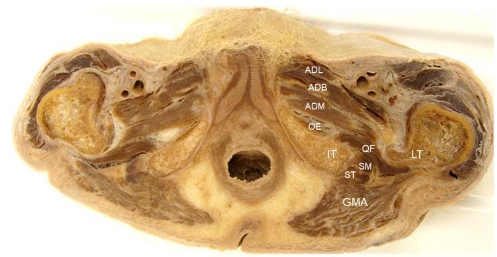 Anatomical Diagram: This axial cross-section of a human cadaver illustrates the musculoskeletal anatomy of the ischiofemoral space, a key region in the diagnosis of ischiofemoral impingement syndrome (IIS). The image identifies the medial boundary formed by the ischial tuberosity (IT) and the lateral boundary formed by the lesser trochanter (LT) of the femur. Centrally, the quadratus femoris muscle (QF) is shown spanning the distance between these two bony landmarks, with the obturator externus muscle (OE) situated deep to it. The adductor muscle group—including the adductor longus (ADL), adductor brevis (ADB), and adductor magnus (ADM)—is positioned medially and anteriorly. Posterior to the ischial tuberosity, the tendons of the semitendinosus (ST) and semimembranosus (SM) are visible, emerging from their proximal attachments. The gluteus maximus (GMA) provides the most superficial posterior layer. This clinical imaging resource provides essential context for understanding the spatial relationships and narrowing of the ischiofemoral and quadratus femoris spaces in pelvic pathology.