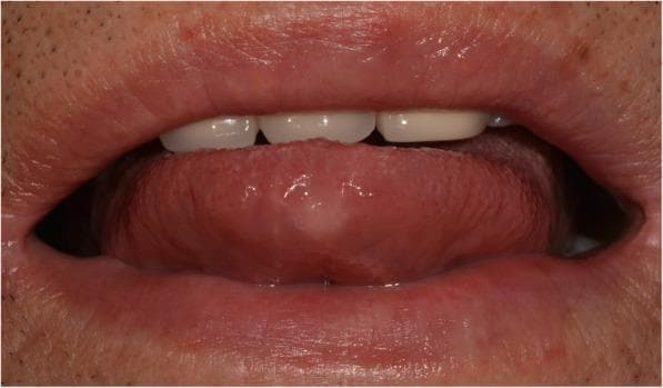 This clinical photograph is an intraoral view of the tongue and anterior oral cavity. The primary finding is a healing lesion located on the anterior dorsal tip of the tongue. Following two months of anti-tuberculosis therapy for lingual tuberculosis, the previously described round, granulomatous ulcer has significantly regressed, now appearing as a subtle, pale, circular area with a flattened surface texture. The surrounding tongue tissue and oral mucosa exhibit a healthy pink color with no signs of active inflammation, erythema, or edema. The dorsal surface of the tongue displays normal filiform and fungiform papillae distribution in the periphery of the resolving site. This image serves as a visual record of clinical improvement and therapeutic response in a case of extrapulmonary tuberculosis presenting as an oral ulcer. The surrounding perioral skin and vermilion border of the lips appear intact and healthy.