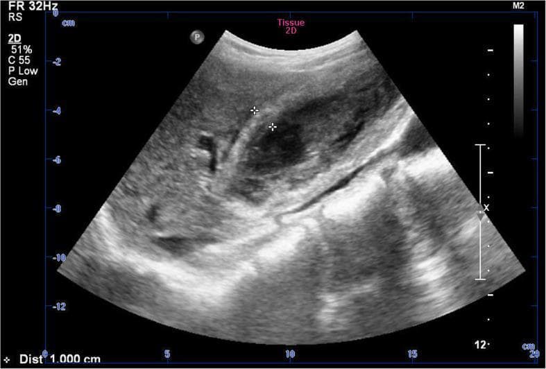 This diagnostic image is a 2D grayscale abdominal ultrasound focusing on the gallbladder. The scan reveals a significantly thickened gallbladder wall, highlighted by calipers measuring a distance of approximately 1.000 cm. Within the gallbladder lumen, there is a prominent, irregular hyperechoic structure that lacks the acoustic shadowing typically associated with gallstones, suggesting intraluminal material such as gallbladder sludge, hemorrhage, or organized clots. The surrounding hepatic parenchyma appears largely homogeneous. This imaging is clinically significant for evaluating cholecystitis, specifically hemorrhagic cholecystitis, as it demonstrates inflammatory wall changes and atypical intraluminal echoes. The visual evidence supports the differential diagnosis between inflammatory processes and potential biliary malignancy in a patient presenting with right upper quadrant pain.