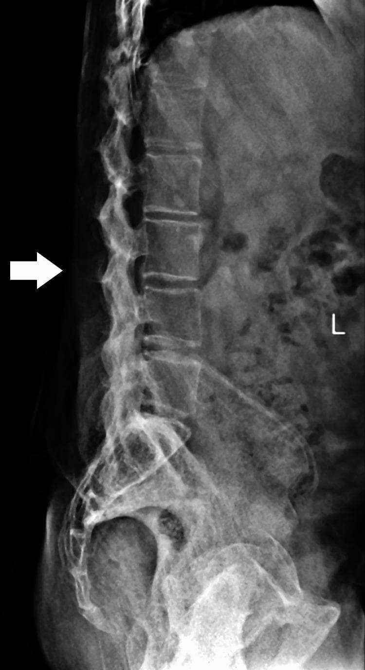 A lateral view X-ray of the lumbosacral spine demonstrating advanced radiographic features of Ankylosing Spondylitis. The image shows the classic 'bamboo spine' appearance, characterized by the formation of thin, vertical marginal syndesmophytes that bridge the intervertebral spaces. There is significant bony ankylosis (fusion) of the vertebral bodies, with blurring and near-complete loss of distinct intervertebral disc spaces. The vertebral endplates appear indistinct and merged. Additional findings include 'squaring' of the lumbar vertebrae and ossification of the spinal ligaments, specifically the interspinous and supraspinous ligaments (indicated by a white arrow pointing to the fused posterior elements). There is a notable loss of the normal lumbar lordosis, suggesting severe spinal stiffness and reduced mobility. The image serves as a definitive educational example of end-stage axial spondyloarthritis involving the lumbar region and sacrum.