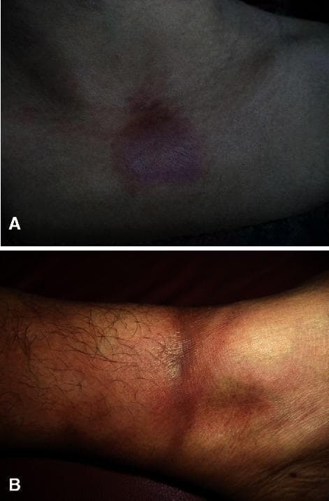 Clinical photograph presenting two distinct morphological variants of morphea (localized scleroderma). Image A displays plaque-type morphea on the upper chest, characterized by a solitary, well-demarcated, oval-shaped plaque with brownish hyperpigmentation and a visibly indurated, slightly waxy texture. Image B illustrates linear morphea on the lower leg, featuring a band-like, hyperpigmented, and indurated lesion that circumferentially involves the limb. Both images demonstrate the characteristic skin thickening and pigmentary changes associated with localized scleroderma. These visuals serve as a comparative educational tool for distinguishing between localized plaque and linear distribution patterns in dermatological diagnosis. The lesions signify an underlying autoimmune-mediated inflammatory process leading to increased collagen deposition in the dermis.