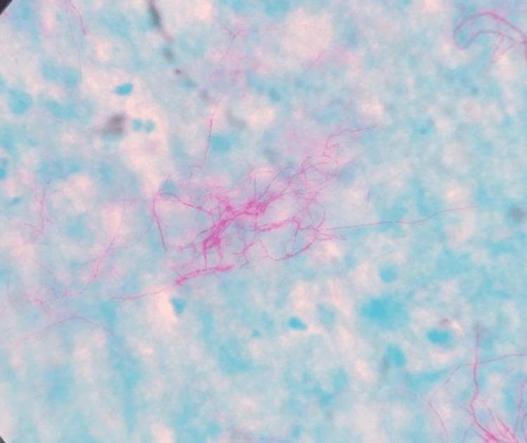 This diagnostic micrograph displays a Modified Ziehl-Neelsen stain (using 1% sulfuric acid) of a clinical specimen, likely pleural fluid. The background is composed of a diffuse light blue counterstain. Predominant in the field are vibrant pink-stained, acid-fast filamentous bacilli. The microorganisms exhibit characteristic slender, elongated morphology with prominent irregular branching patterns and a beaded appearance in some areas. These visual features are highly suggestive of Nocardia species, an opportunistic pathogen. The image demonstrates the microscopic diagnostic approach for identifying aerobic actinomycetes in immunocompromised patients, such as those with HIV. The filamentous nature distinguishes these organisms from other acid-fast bacilli like Mycobacterium tuberculosis, which typically appear as non-branching rods.