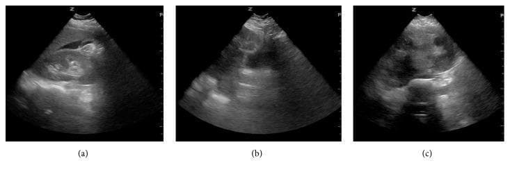 A composite of three grayscale ultrasound images (labeled a, b, and c) demonstrating clinical findings in a trauma setting. Image (a) shows a Focused Assessment with Sonography for Trauma (FAST) scan of the right upper quadrant. It reveals a wedge-shaped anechoic (black) area between the liver and the right kidney, representing free intraperitoneal fluid (hemoperitoneum) in Morison's pouch. Images (b) and (c) provide sagittal and transverse pelvic views, respectively, displaying the uterus. These images reveal incidental findings of leiomyomata uteri (uterine fibroids), appearing as multiple, well-circumscribed, hypoechoic to heterogeneously echogenic masses within the uterine myometrium. The presentation illustrates both acute traumatic pathology (positive FAST) and incidental gynecological findings that may complicate clinical management in emergency medicine and trauma surgery.