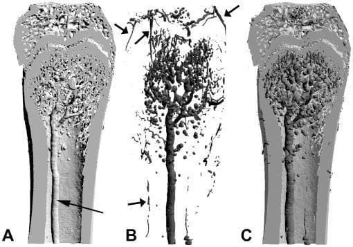 This composite of three 3D surface-rendered models (A, B, and C) illustrates the spatial relationship between bone macrostructure and microvasculature, likely in a mammalian femur model.
Panel A shows an undecalcified bone model displaying the cortical shaft, marrow cavity, and trabecular network in the metaphysis. A central medullary artery (arrow) is visible running longitudinally.
Panel B depicts the vascular cast alone after decalcification, highlighting the nutrient artery, its primary branches, and a dense network of sinusoid capillaries within the metaphysis. External arrows point to the periosteal arteries and branched peripheral networks.
Panel C demonstrates the over-imposition of both models, utilizing pseudo-coloring to differentiate the calcified bone matrix (lighter gray) from the internal and external vascular systems (darker gray).
The imaging modality is micro-computed tomography (µCT) with vascular contrast agents, designed to study bone-vessel interactions, such as those occurring in normal physiology or pathological states like metastasis or osteolysis. The visualization highlights anatomical regions including the diaphysis, metaphysis, and epiphysis.