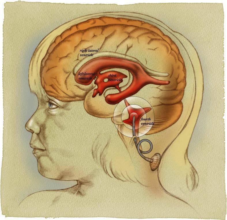 This medical illustration depicts an anatomical diagram of the human brain's ventricular system in a sagittal view, highlighting the surgical placement of a fourth ventricle catheter and ventricular access device (VAD). The ventricular system is rendered in red, showing the bilateral C-shaped lateral ventricles, the centrally located third ventricle, and the diamond-shaped fourth ventricle in the posterior fossa near the brainstem and cerebellum. A gray ventricular catheter is shown inserted directly into the fourth ventricle, positioned parallel to the ventricular floor. The catheter exits the cranium and incorporates a 'relief loop' designed to prevent mechanical tension during neck movement. It terminates in a subcutaneous VAD positioned at the base of the neck/posterior scalp area. This illustration serves to demonstrate a neurosurgical approach for direct ventricular access, often utilized for localized chemotherapy delivery or cerebrospinal fluid (CSF) management. Key anatomical landmarks include the cerebral cortex, brainstem, and the suboccipital region where the surgical incision and device tunneling occur.