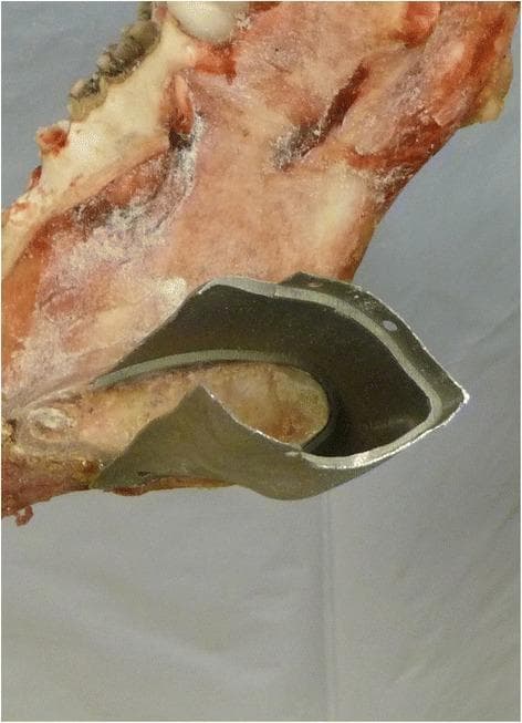 A close-up clinical photograph of a cadaveric specimen demonstrating a mandibular reconstruction interface. The image shows a metallic, custom-manufactured titanium implant designed for a 'tube-in-tube' connection with a resected bone stump. The bone has been surgically prepared with a circular step, creating a precise diameter reduction that allows the implant to sleeve over the stump with a high degree of congruency. The implant features a smooth, machined finish and a contoured edge that mimics the anatomical cross-section of the mandible. Several small, circular pre-drilled holes are visible along the perimeter of the implant’s overlapping collar, intended for secondary stabilization using surgical fixation screws. This visual highlights advanced maxillofacial surgical techniques using CAD/CAM technology and laser sintering (LaserCUSING®) to achieve high-precision fitting in ablative tumor surgery reconstructions. The educational focus is on the biomechanical stability and anatomical integration of patient-specific implants in head and neck surgery.