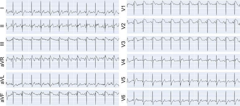 A standard 12-lead electrocardiogram (ECG) tracing presented in a 2x6 grid format. The left column displays the limb leads (I, II, III, aVR, aVL, and aVF), while the right column shows the precordial leads (V1 through V6). The image illustrates a synthesized normal cardiac rhythm with clearly identifiable waveform components: P waves representing atrial depolarization, narrow QRS complexes indicating ventricular depolarization, and T waves representing ventricular repolarization. The isoelectric lines are stable, and the R-R intervals are regular, suggesting a normal sinus rhythm. Lead II shows upright P waves and a predominant R wave, while lead aVR shows the expected global inversion. The precordial leads (V1-V6) demonstrate normal R-wave progression from right-to-left across the chest. This visual is used to teach basic ECG interpretation, waveform morphology recognition, and the spatial arrangement of cardiac electrical vectors in clinical cardiology.