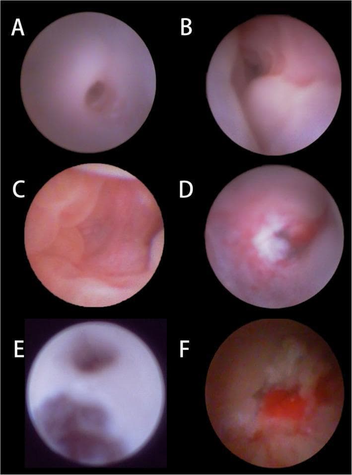 A series of six dacryoendoscopic images (A-F) illustrating the clinical appearance of the lacrimal drainage system in pediatric patients with membranous congenital nasolacrimal duct obstruction (CNLDO). Image A shows a normal, smooth lacrimal canaliculus for baseline comparison. Image B depicts the common canalicula area including the Valve of Rosenmüller. Images C-F highlight various pathological findings associated with failed prior probing and persistent obstruction: (C) shows the primary obstruction point at the distal end of the nasolacrimal duct (NLD); (D) demonstrates an irregular, white-colored scar between the lacrimal sac and the canaliculus; (E) reveals a false passage near the common canaliculus, a common complication of blind probing; and (F) displays mucosal inflammation with associated purulent secretions within the duct. These images provide critical diagnostic visual markers for ophthalmologists identifying reasons for probing failure, such as scarring, false passages, or persistent distal membranes (Hasner's valve), and emphasize the utility of direct endoscopic visualization for precise surgical management.