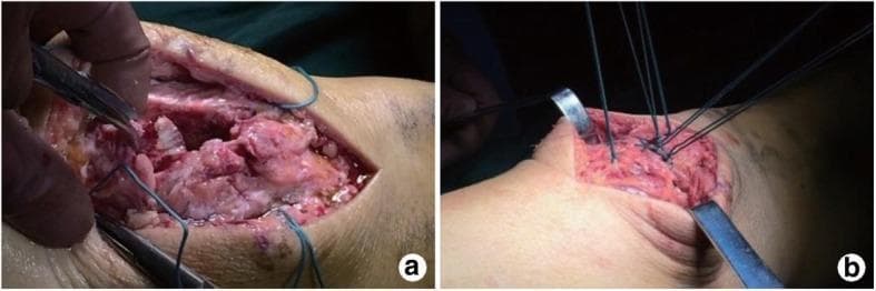 Two-part intraoperative clinical photograph demonstrating a 'three-dimensional strapping reduction' technique for a comminuted patellar fracture. Panel (a) shows the initial surgical exposure through a vertical incision, revealing multiple irregular bone fragments of the patella. Heavy blue non-absorbable sutures are seen being threaded from the fracture end through the patellofemoral joint into the surrounding soft tissue, with surgical forceps manipulating the tissue. Panel (b) illustrates the reduction phase where the sutures are gathered and tightened toward the center, effectively approximating the bone fragments under direct vision. The sutures are tied on the anterior surface of the patella, creating a stabilized construct before definitive internal fixation. This orthopedic procedure is designed to achieve anatomical reduction of the articular surface and the patellofemoral joint in complex fracture patterns.
