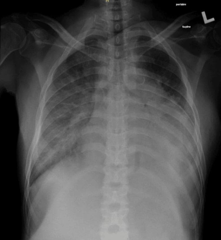 Anteroposterior (AP) supine chest radiograph demonstrating bilateral, diffuse airspace opacities consistent with flash pulmonary edema. The opacification is most pronounced in the perihilar regions, exhibiting a classic 'bat-wing' distribution that obscures the underlying pulmonary vasculature. The heart silhouette appears relatively normal in size, suggesting a non-cardiogenic or acute fluid overload etiology rather than chronic congestive heart failure. Costophrenic angles are partially obscured by the overlying opacities. The mediastinal contours remain within normal limits, and the trachea is midline. This diagnostic image illustrates key radiological findings of acute alveolar edema, often secondary to hypertensive crisis or renal failure, suitable for medical instruction on thoracic imaging and fluid management.