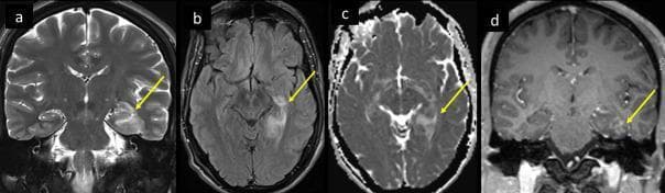 This diagnostic image set consists of four MRI brain sequences—(a) Coronal T2, (b) Axial T2-FLAIR, (c) Apparent Diffusion Coefficient (ADC) map, and (d) Coronal T1 post-contrast—demonstrating characteristic findings of medial temporal lobe encephalitis. Yellow arrows across all sequences highlight pathology in the left hippocampus and medial temporal lobe. The Coronal T2 and Axial FLAIR images show abnormal high signal intensity and mild swelling of the hippocampus and parahippocampal gyrus. The ADC map reveals facilitated diffusion (hyperintensity) in the corresponding region, indicating vasogenic edema rather than acute infarction. The T1 post-contrast image displays patchy parenchymal enhancement within the affected medial temporal structures, suggesting blood-brain barrier breakdown or inflammation. These findings are clinically significant for diagnosing encephalitis patterns, such as those associated with viral infections (including SARS-CoV-2) or autoimmune etiologies, targeting the limbic system.