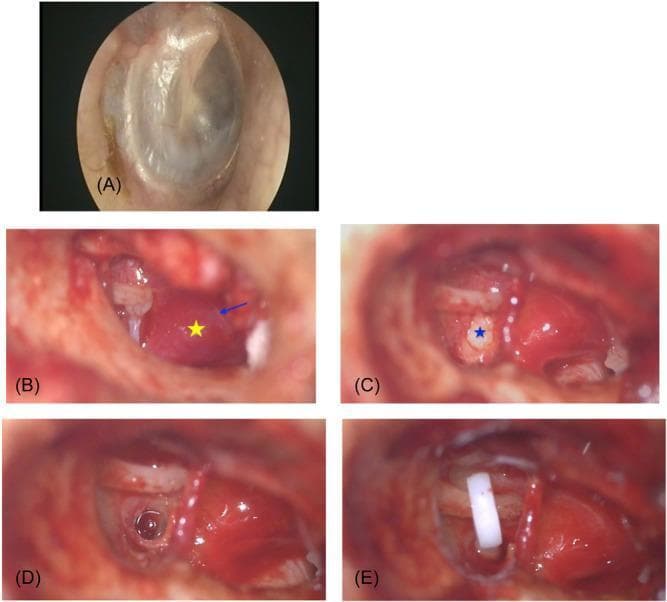 This composite of clinical otoendoscopic and intraoperative microscopic photographs illustrates the surgical management of otosclerosis. Image A shows a normal tympanic membrane. Image B, captured after elevation of the tympanomeatal flap, reveals a prominent Schwartze sign, characterized by a diffuse reddish vascular hyperemic area over the promontory (marked with a yellow star); Jacobson's nerve is indicated by a blue arrow. Image C demonstrates an otosclerotic stapes footplate, appearing white, thickened, and sclerotic (marked with a blue star). Image D shows the subsequent stapedotomy, with a precise circular perforation created in the footplate. Image E depicts the final stage of the intervention: the placement of a white Teflon piston prosthesis connecting the long process of the incus to the stapedotomy site. This sequence serves as an educational tool for identifying middle ear pathology and the steps of stapedectomy/stapedotomy, emphasizing the anatomical relationships between the incus, stapes, promontory, and Jacobson's nerve in the middle ear cavity.