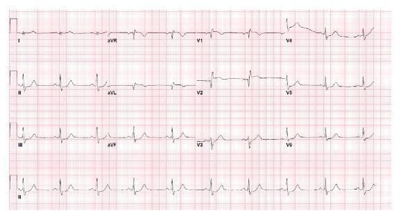 A 12-lead electrocardiogram (ECG) printed on standard grid paper demonstrating acute ST-segment changes consistent with myocardial ischemia or infarction. The tracing shows sinus bradycardia with a heart rate of approximately 56 beats per minute. Primary abnormalities include significant ST-segment elevation in the septal leads (V1, V2) and the high lateral lead (aVL). Corresponding reciprocal ST-segment depression is visible in the inferior leads (II, III, and aVF) as well as the lateral precordial leads (V5 and V6). The morphology of the ST elevation in V1-V2 is indicative of an acute anteroseptal injury pattern. This ECG serves as an educational example of how traumatic cardiac contusion or coronary artery occlusion can present with classic ST-elevation myocardial infarction (STEMI) patterns, requiring urgent clinical correlation with echocardiography and potentially cardiac catheterization.