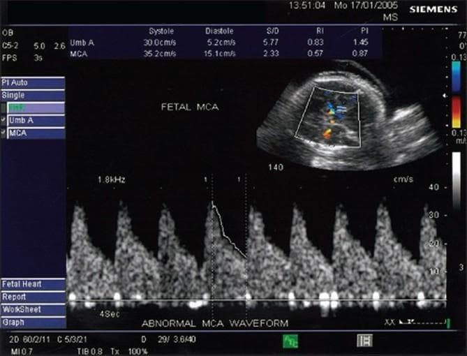 Diagnostic ultrasound image demonstrating fetal middle cerebral artery (MCA) Doppler velocimetry in a case of intrauterine growth restriction (IUGR). The image includes a 2D grayscale fetal head cross-section in the upper right with a color Doppler gate positioned over the Circle of Willis to identify the MCA. The lower portion displays a spectral Doppler waveform labeled 'ABNORMAL MCA WAVEFORM.' The waveform shows a low-resistance pattern characterized by high end-diastolic flow (15.1 cm/s) relative to peak systolic velocity (35.2 cm/s). On-screen calculations indicate a Pulsatility Index (PI) of 0.87 and a Resistive Index (RI) of 0.57. For comparison, umbilical artery (Umb A) data is also listed (PI 1.45), suggesting a reversed cerebro-umbilical (C/U) ratio. This visual finding is characteristic of the 'brain-sparing effect,' where cerebral vasodilation occurs as a compensatory mechanism for chronic fetal hypoxia and placental insufficiency.
