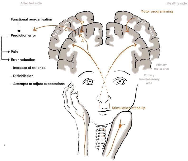 A pathophysiology diagram illustrating theoretical models of phantom limb pain (PLP) through cortical reorganization. The image displays a coronal cross-section of the brain, comparing a 'Healthy side' and an 'Affected side' (post-amputation). On the healthy side, stimulation of the lip correctly activates the face representation in the primary somatosensory area (S1), while motor programming activates the hand representation in the primary motor area. On the affected side, functional reorganization is shown where lip stimulation erroneously activates both the face and the amputated hand's S1 representation. This mismatch is labeled as a 'Prediction error,' leading to the perception of 'Pain.' Three theoretical pathways are identified: (A) Maladaptive plasticity, where neural activation directly involves nociceptive neurons; (B) Persistent pain representation, involving motor-to-S1 feedback; and (C) Predictive coding, where the system attempts 'Error reduction' through increased salience, disinhibition, and attempts to adjust expectations. This schematic serves as a medical educational tool for understanding neuroplasticity and the sensory-motor incongruency underlying neuropathic pain syndromes.